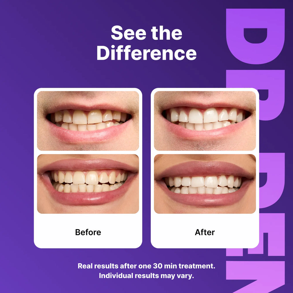 DRDENT Purple Teeth Whitening Strips - 7/21 Whitening Sessions - Non Sensitive Teeth Whitening - Peroxide-Free